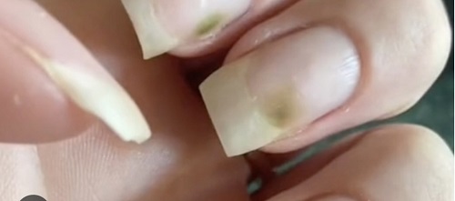 infiltration ongles